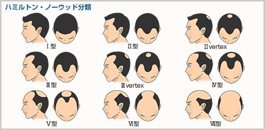 【医師が解説】AGAかどうかの判断基準の画像