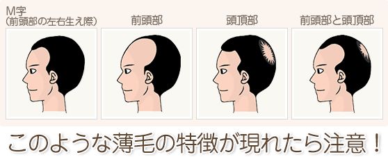 【医師が解説】ストレスによる抜け毛は一時的なもの？それともAGA？の画像