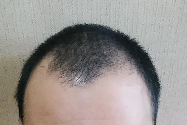 M字ハゲでも出来る髪型 おすすめヘアスタイル Aga治療と病院検索ならagaケアナビ